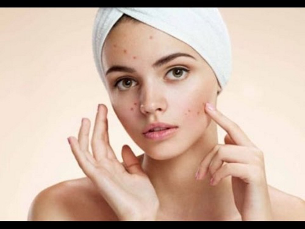 طرق طبيعية لعلاج حب الشباب