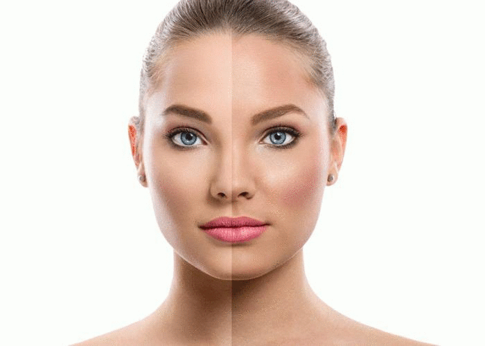 طرق طبيعية لإزالة الكلف