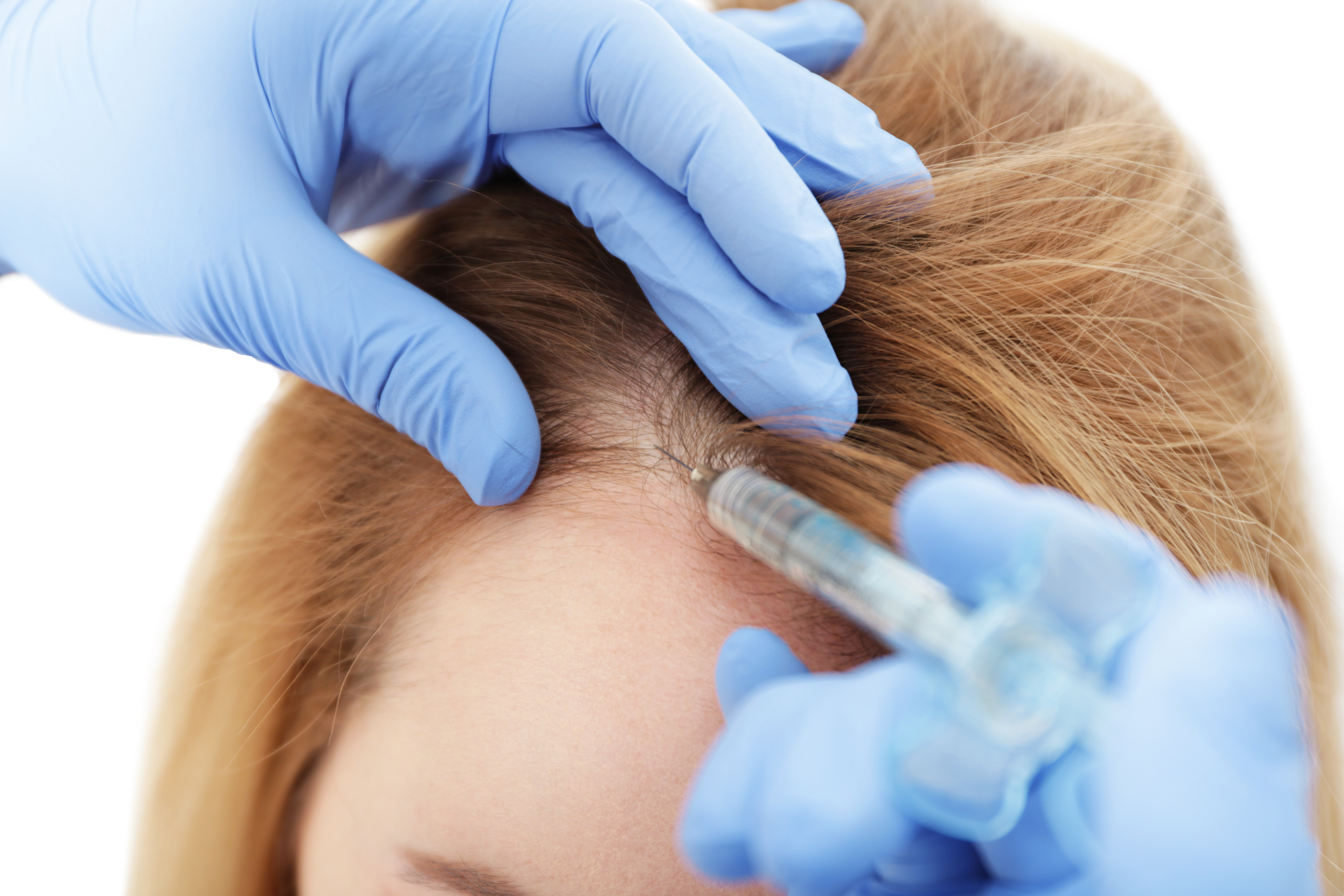 زراعة الشعر 