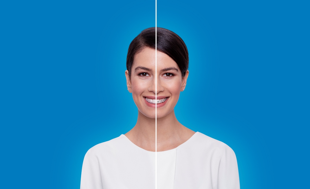 جرّبي علاج Invisalign للحصول على إبتسامة جذابة