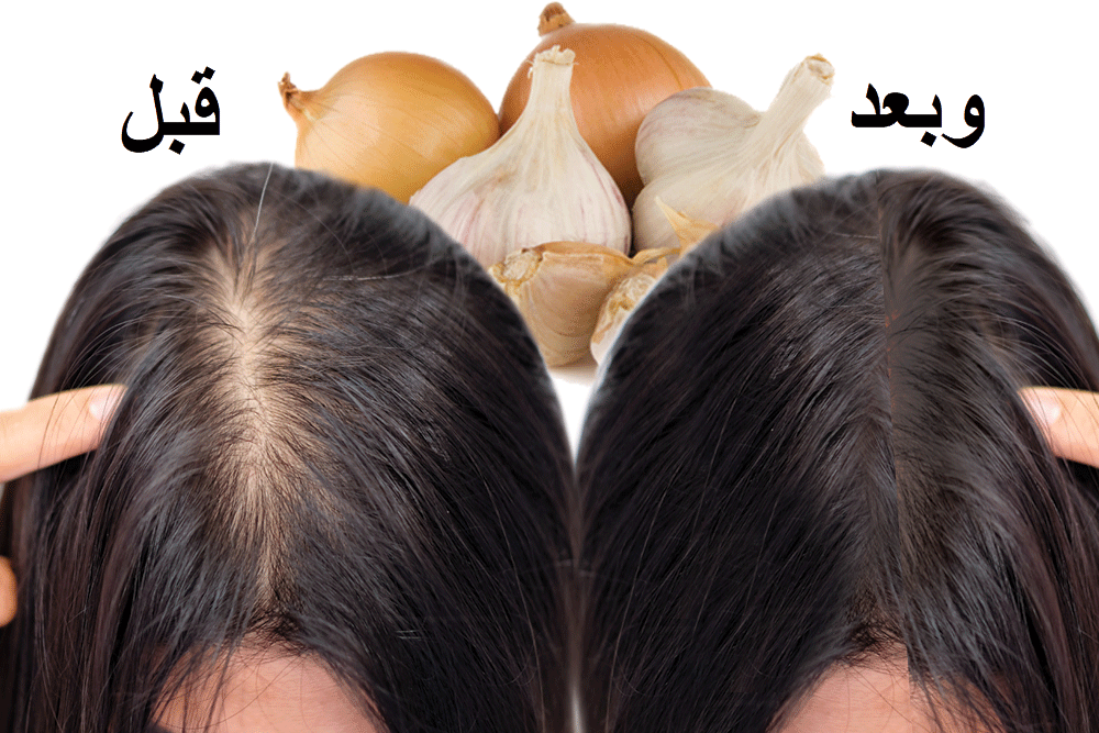 علاج الشعر بعد الكيمياوي