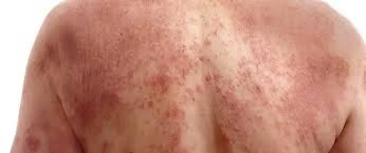 جسد شخص تعرض لاشعة الشمس.jpg