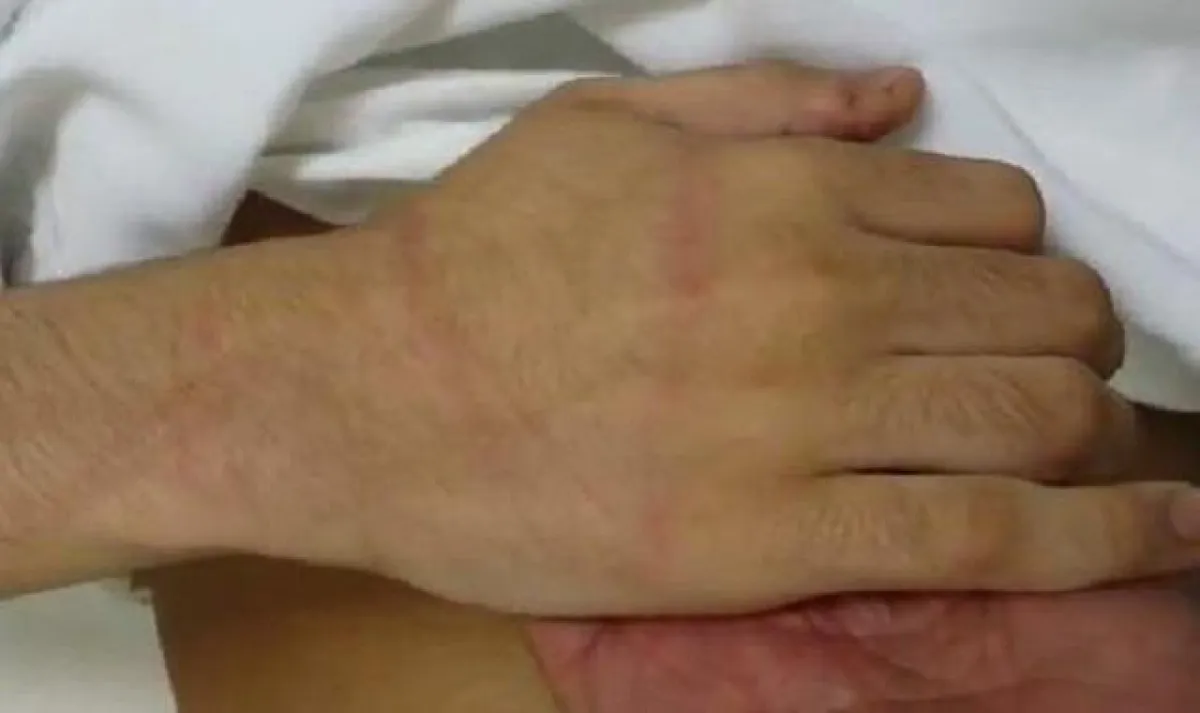 نزيل من ذوي الاحتياجات الخاصة يتعرض للتعنيف والحرق في القنفذة
