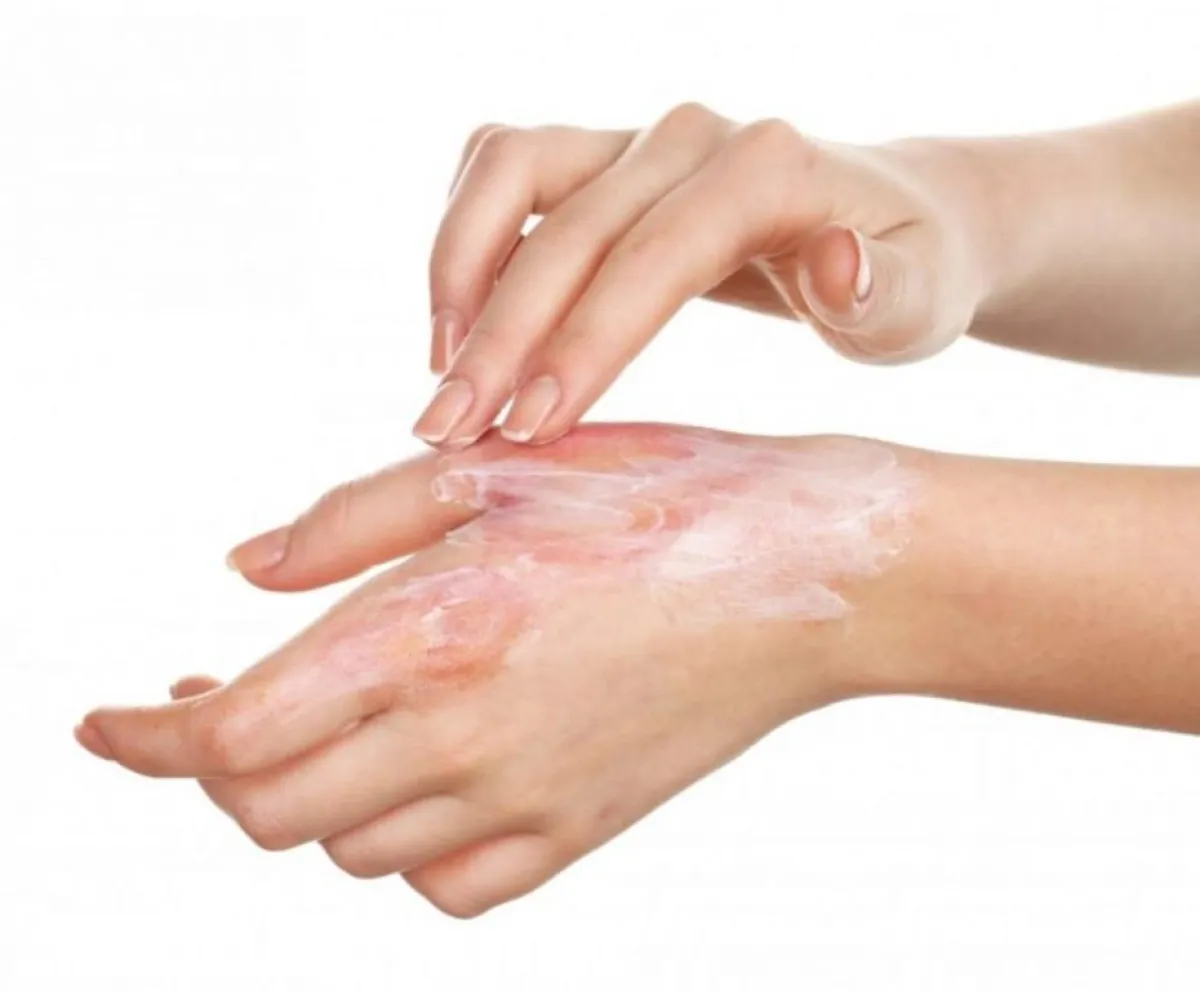 تعرَّفي على إرشادات العناية بالحروق