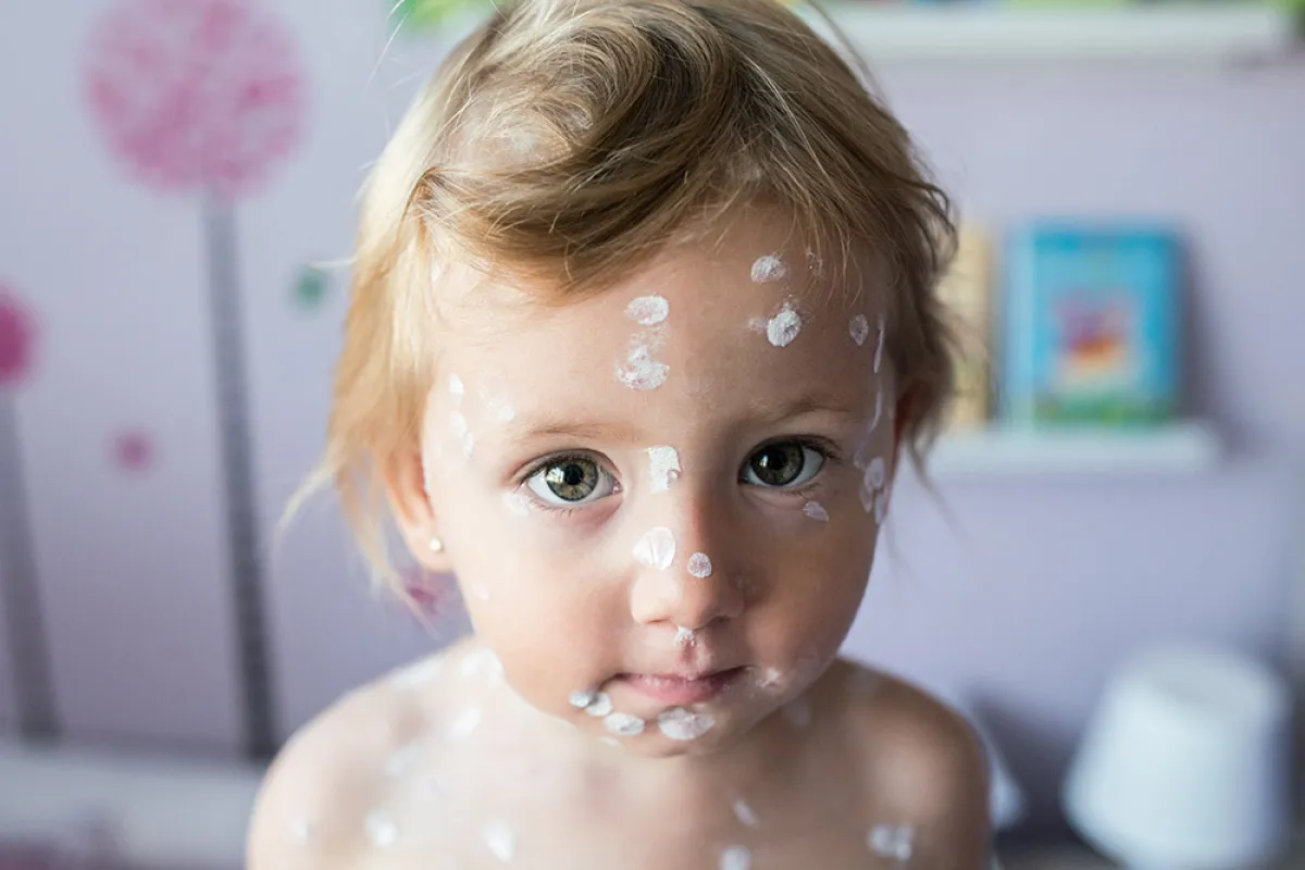  جدري الماء عند الرضع