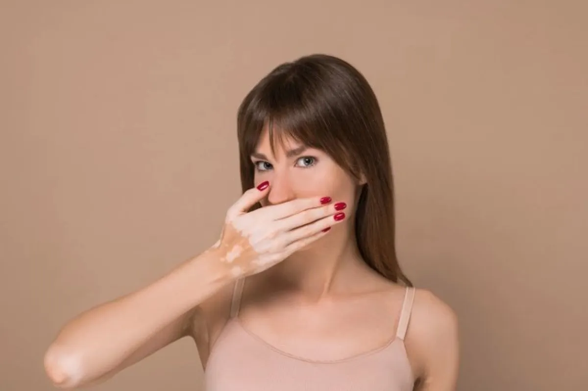 مكياج للبهاق