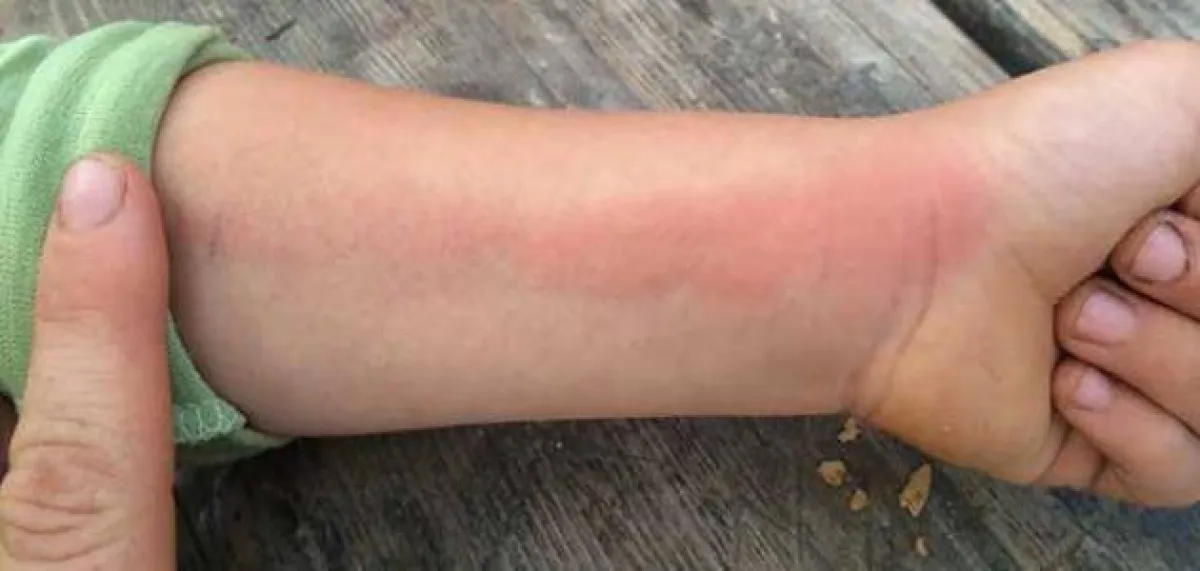 إنتنان الدم هي حالة تهدد الحياة إذا لم يتم علاجها في وقت مبكر