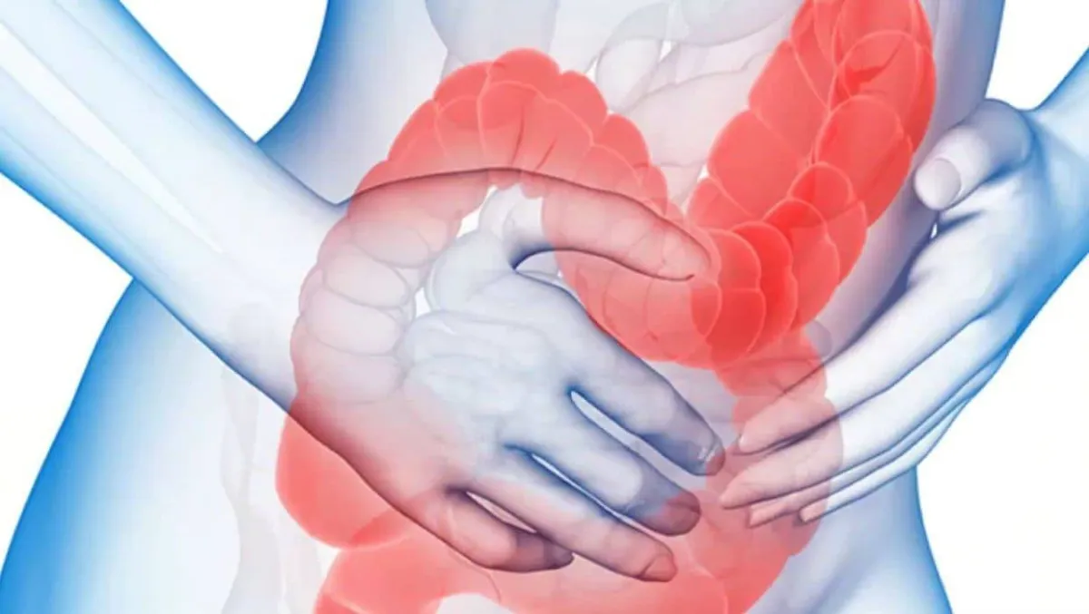 سرطان القولون