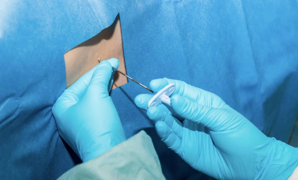 صورة لإبرة الظهر