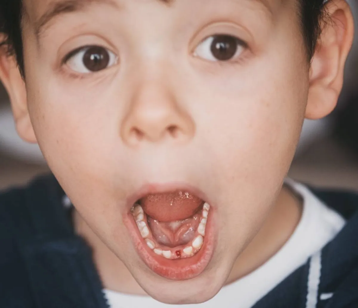 صورة لطفل كسر سنّه