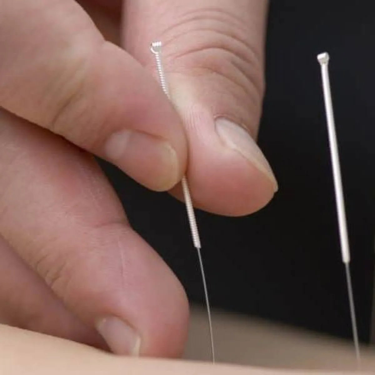 صورة لطبيب يستخدم الوخز بالإبر