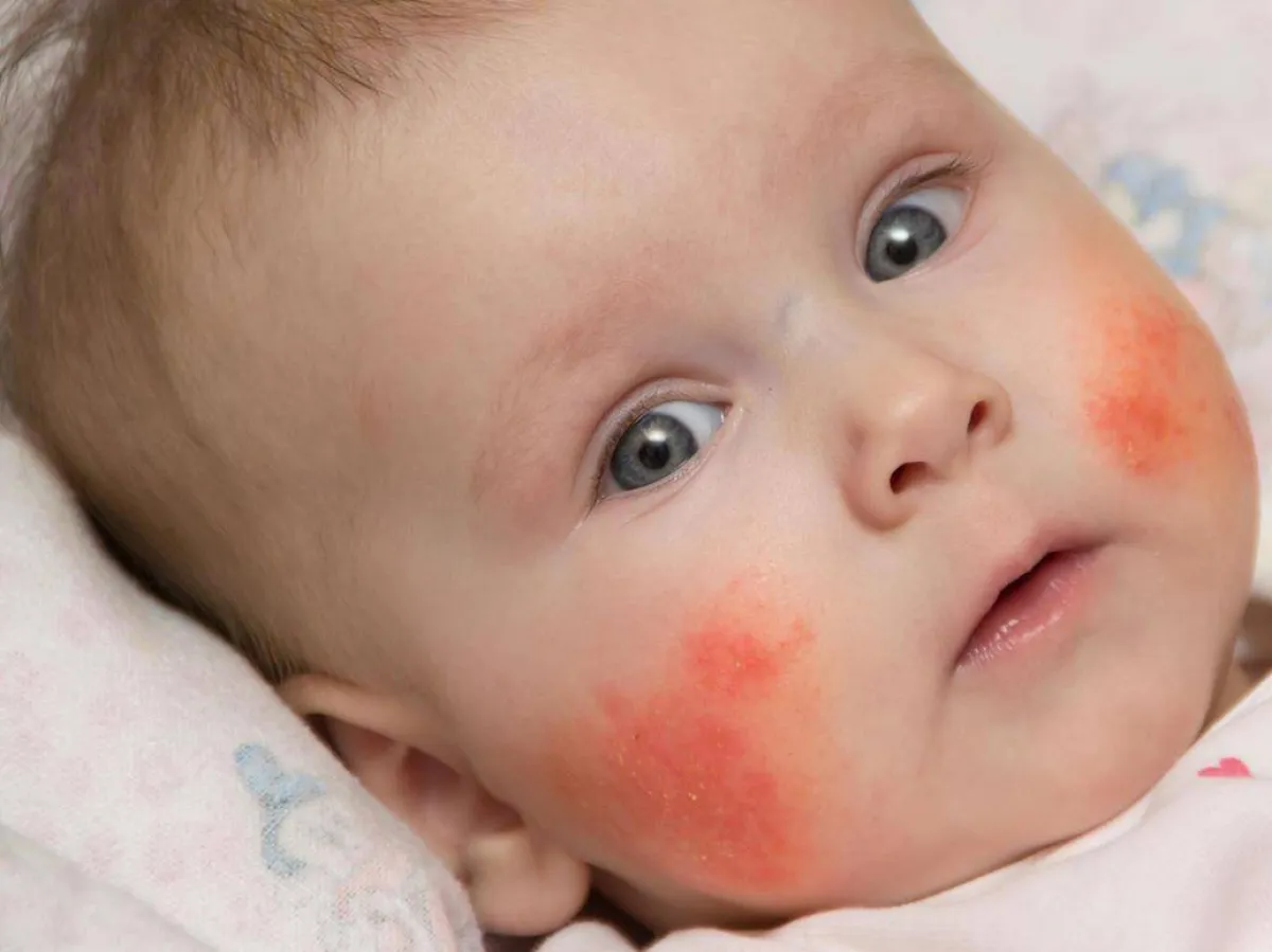 صورة لأكزيما الأطفال