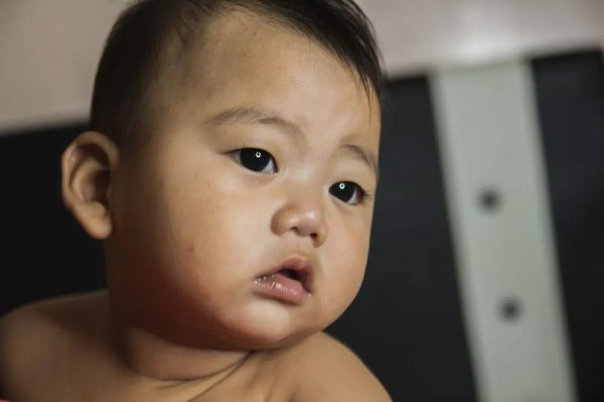 صورة لطفل يعاني من الأكزيما