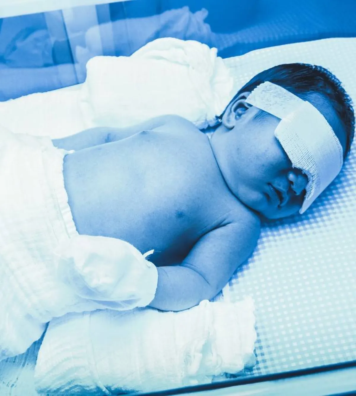 صورة طفل مصاب بالصفراء