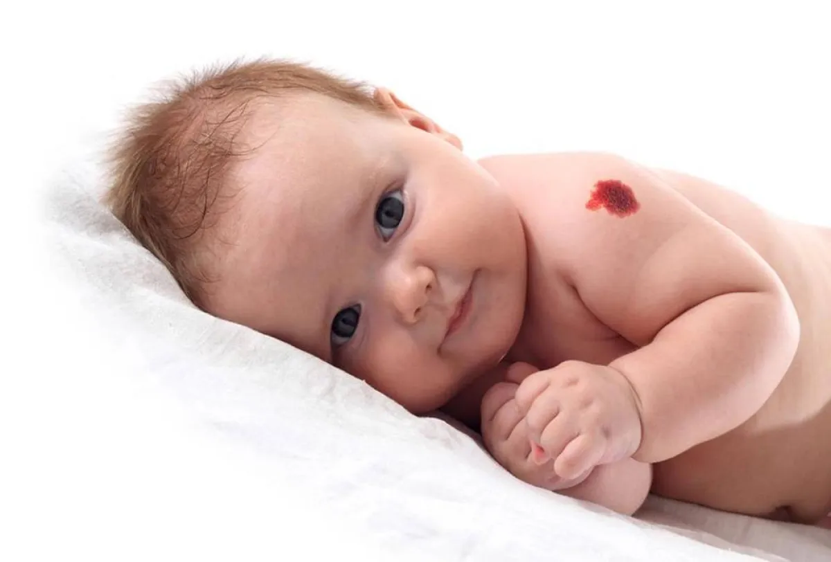   صورة لطفل يعاني من الشامات 