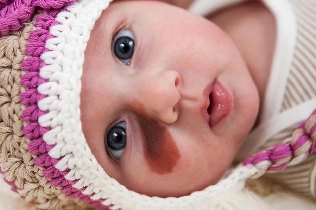 صورة لطفل رضيع لديه شامة غامقة اللون  