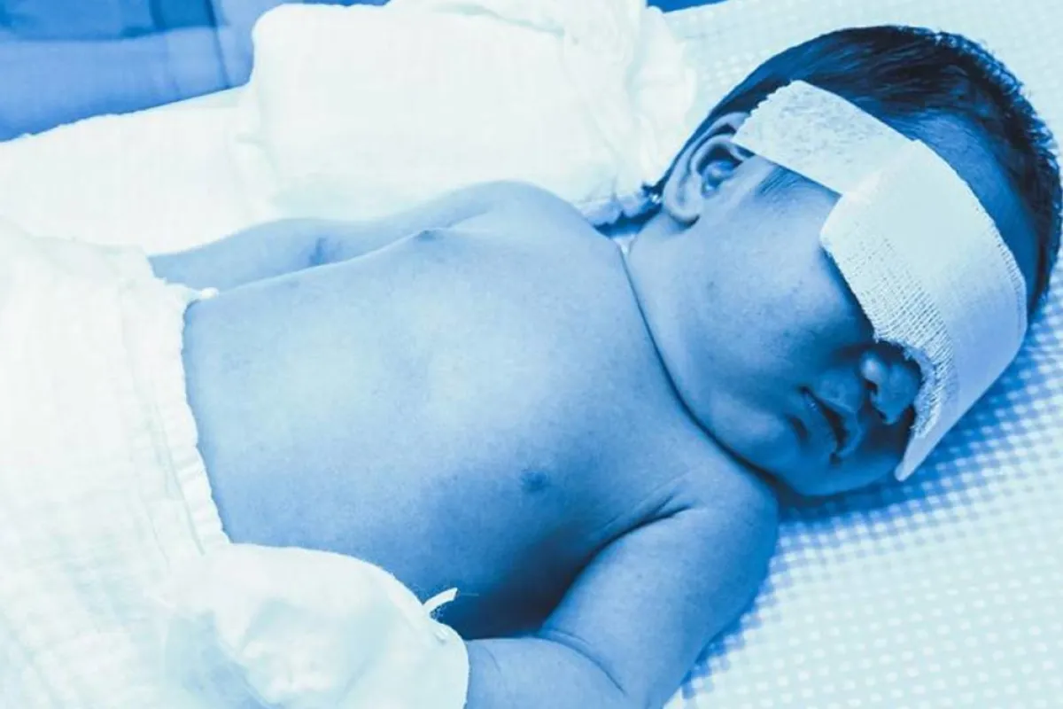 صورة طفل مصاب بالصفراء