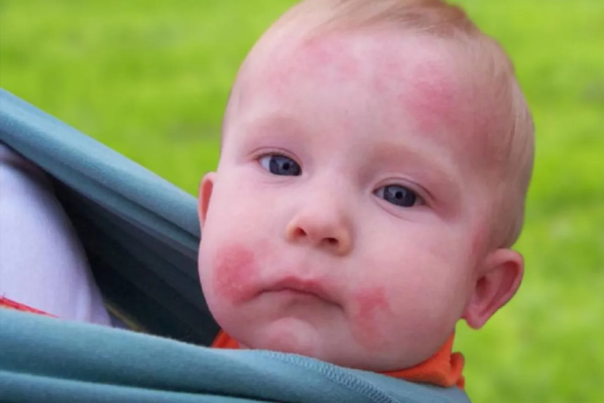 صورة لطفل يعاني من الطفح الجلدي