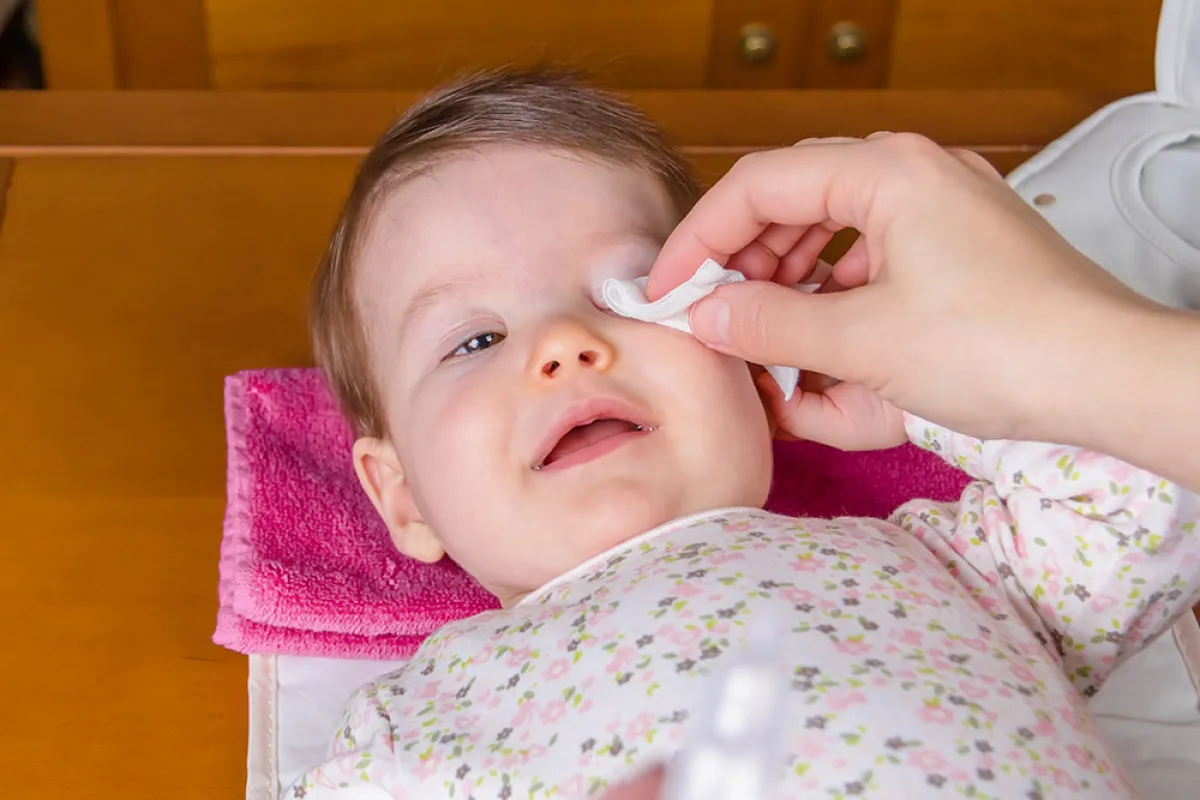 تدلي الجفن الخلقي عند الأطفال أسبابه وطرق علاجه