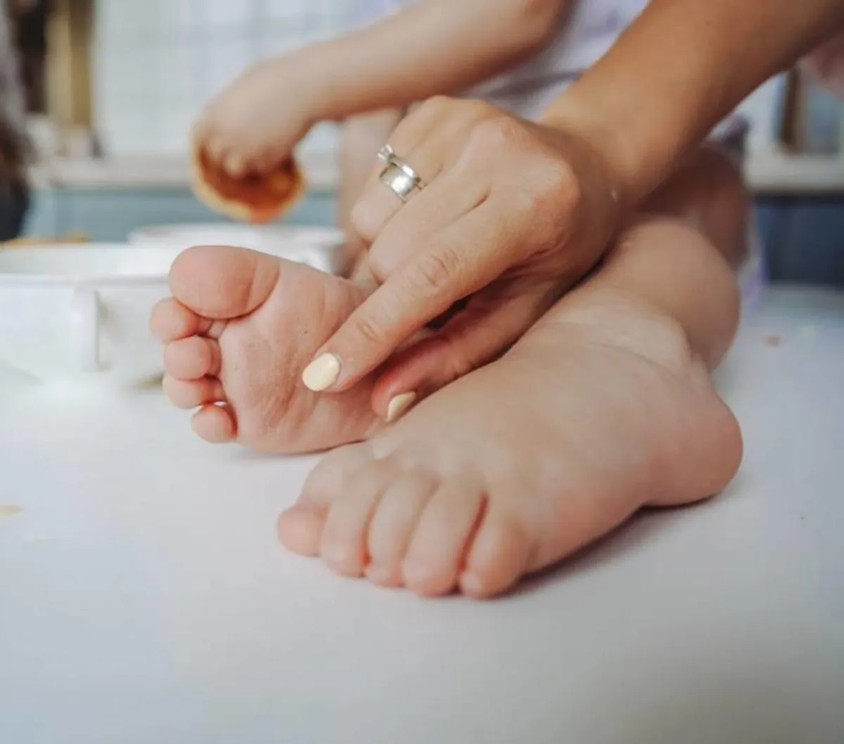 صورة لحروق سطحية