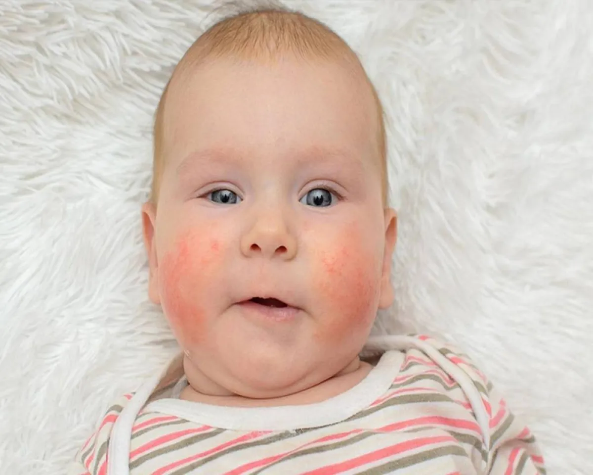 صورة لطفل مصاب بحساسية الوجه