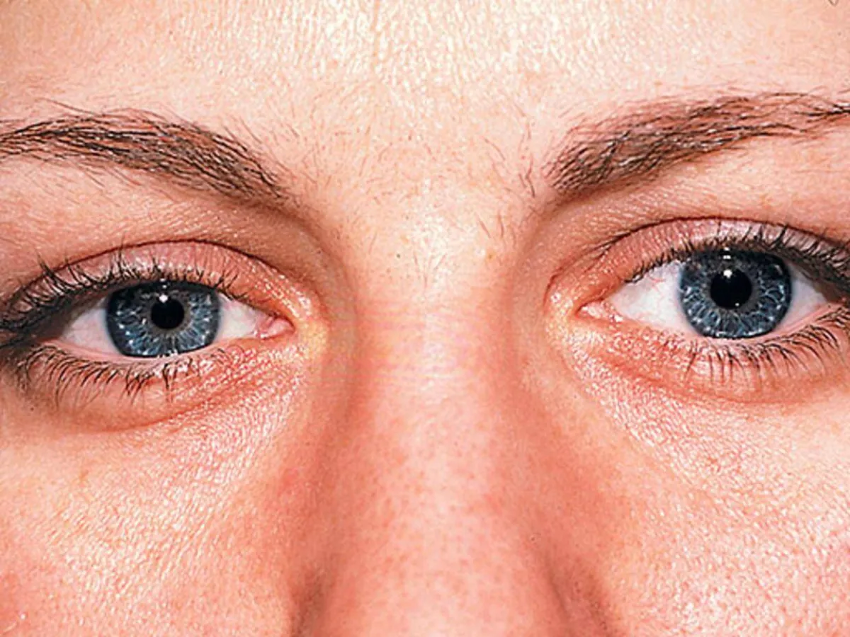 معرفة ارتفاع الكوليسترول من خلال عينيك 