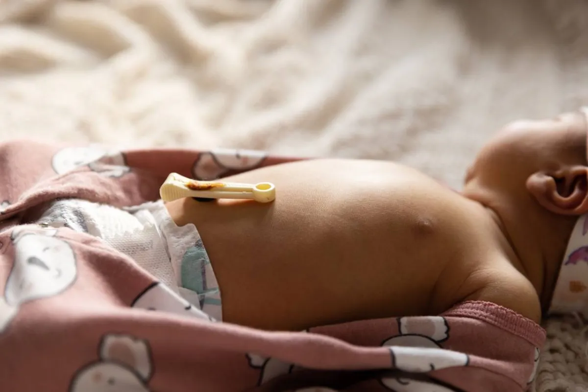 صورة لمولود بعد قص الحبل السرّي