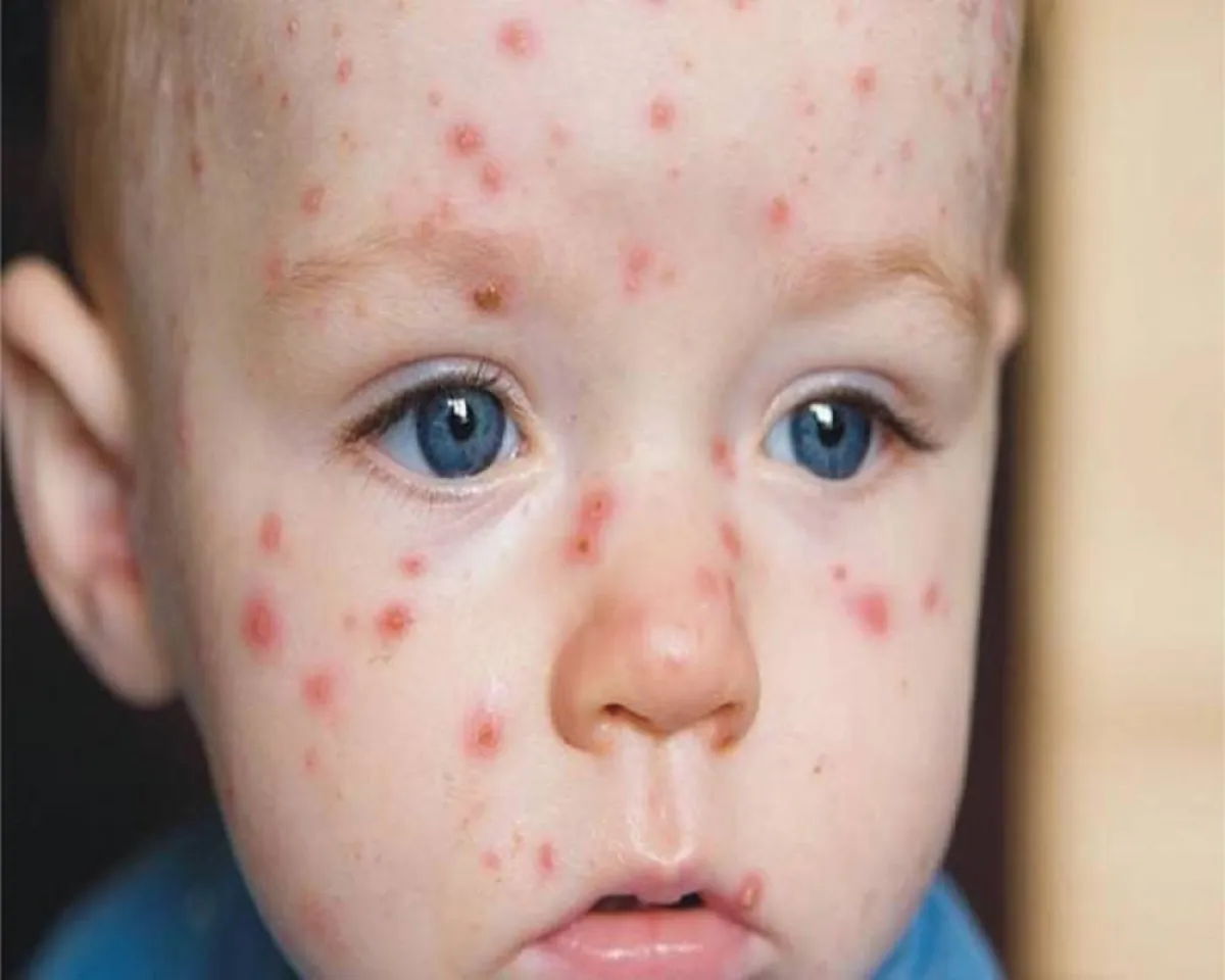 صورة لطفل يعاني من حساسية الوجه وحب الشباب