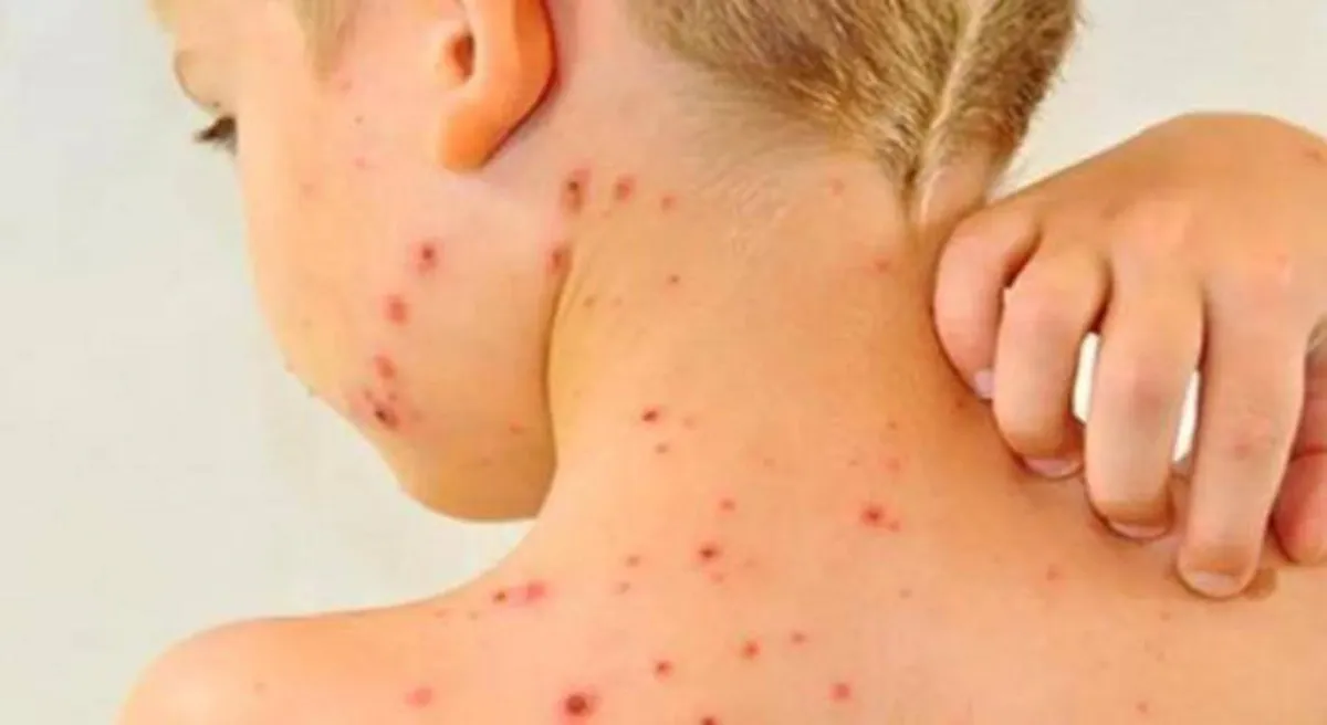صورة لطفل يعاني من الحصبة