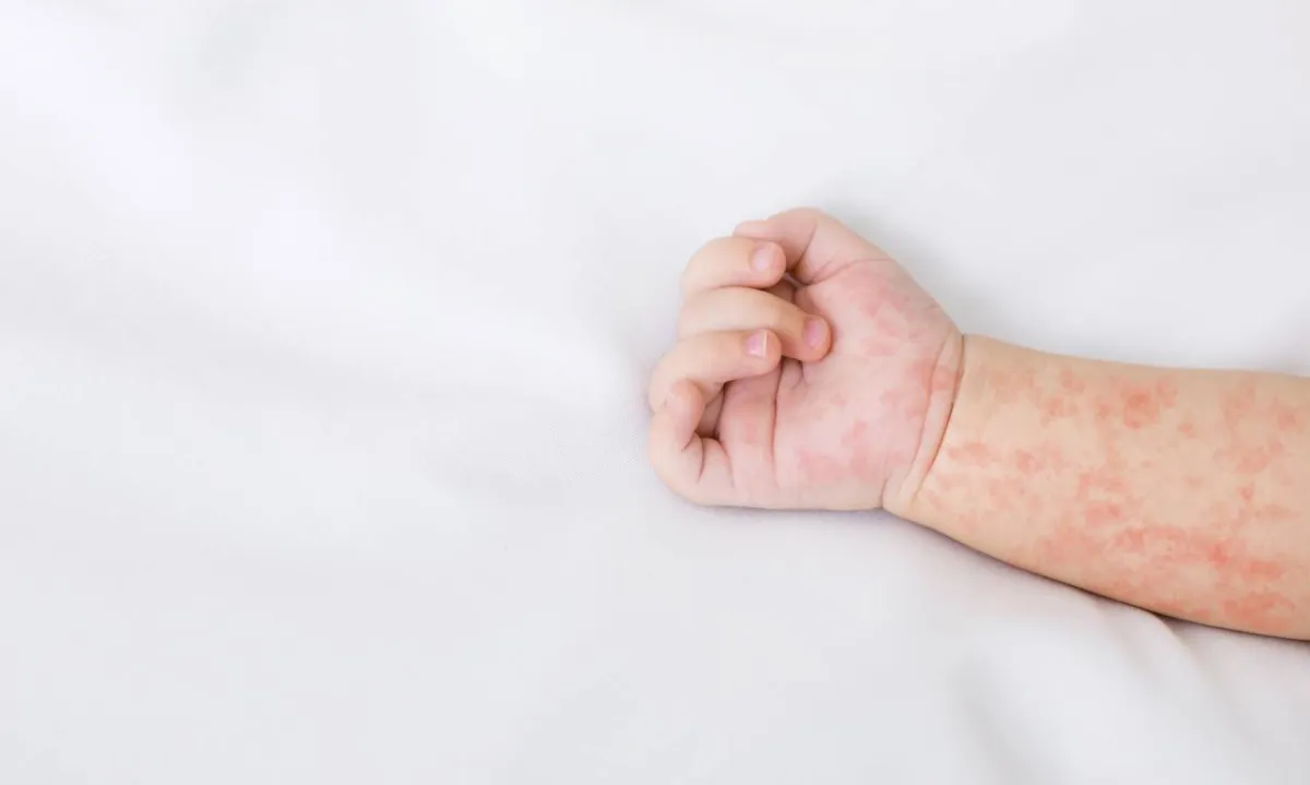 صورة لمولود يعاني من الطفح الجلدي