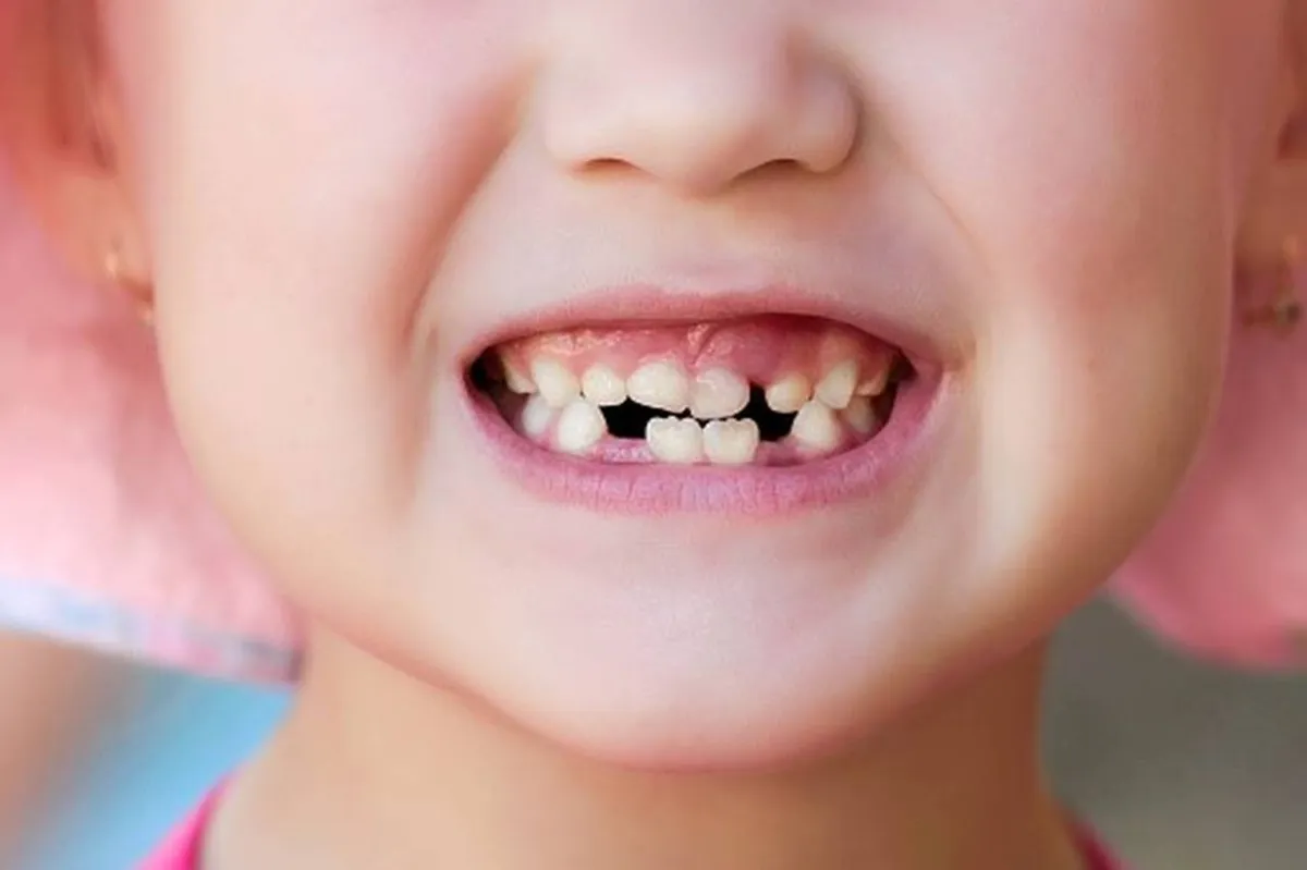 صورة تعبيرية لنقص الكالسيوم