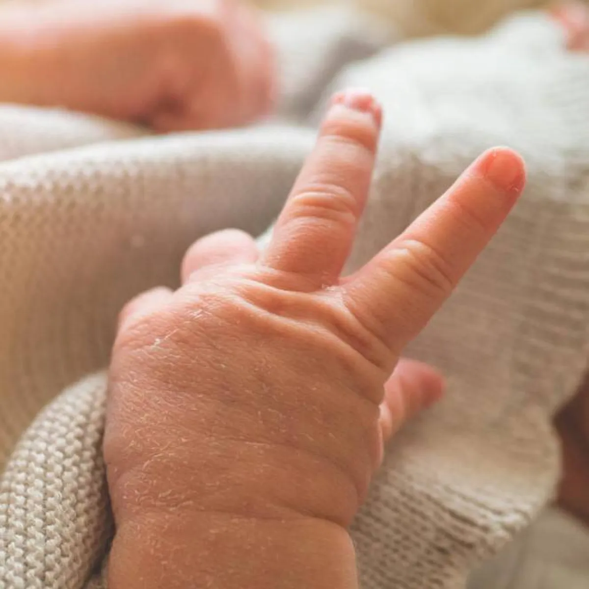 صورة لتقشر جلد الرضيع