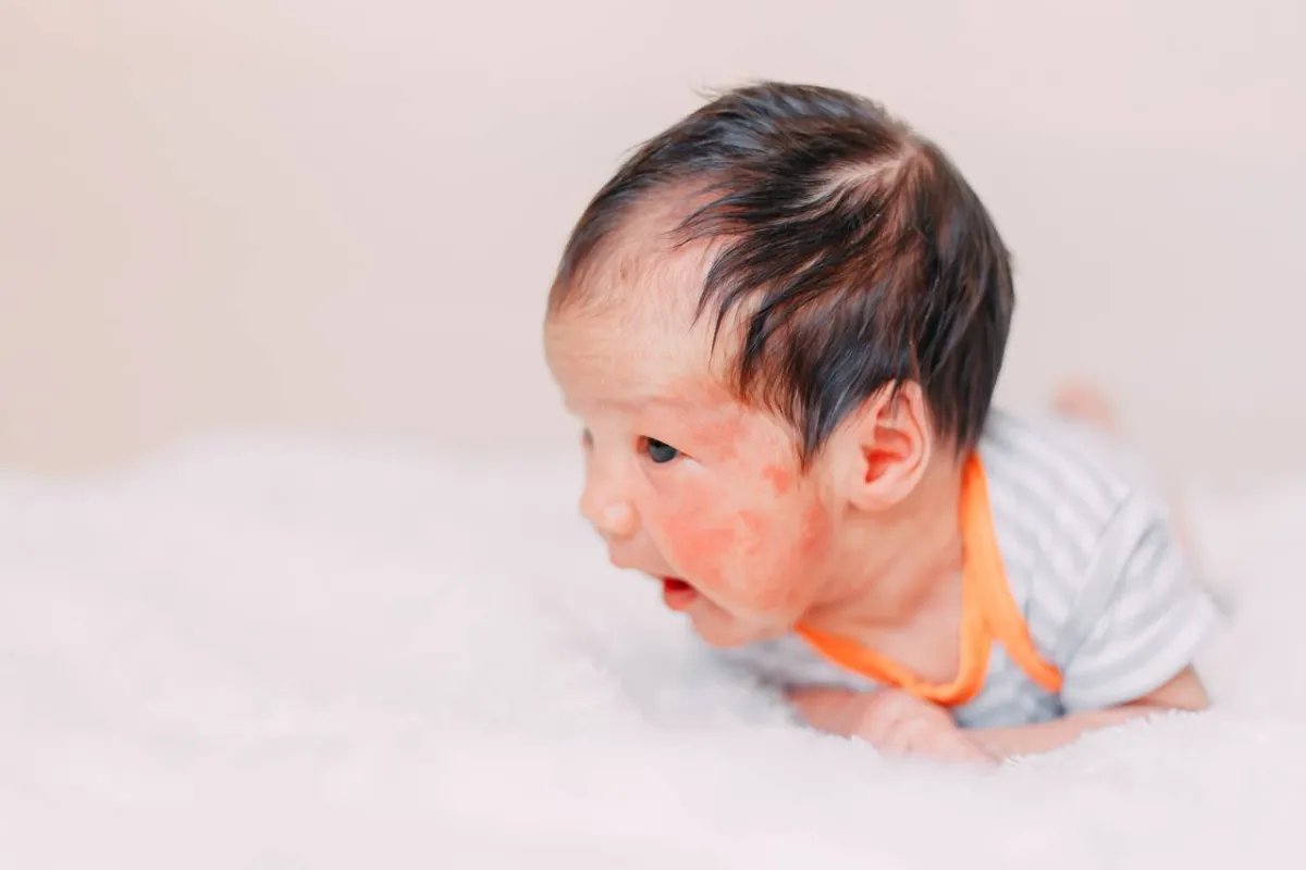 صورة لجفاف وجه المولود