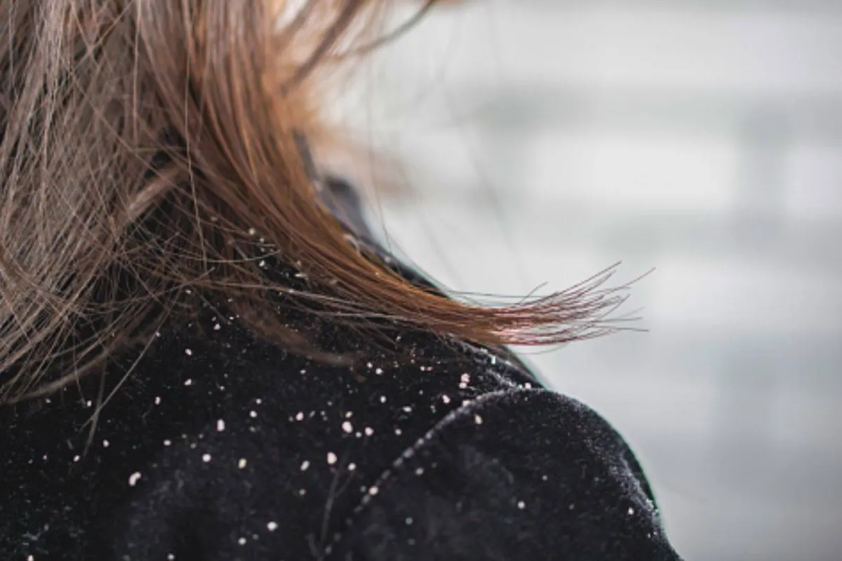 تفسير حلم قشرة الشعر في المنام