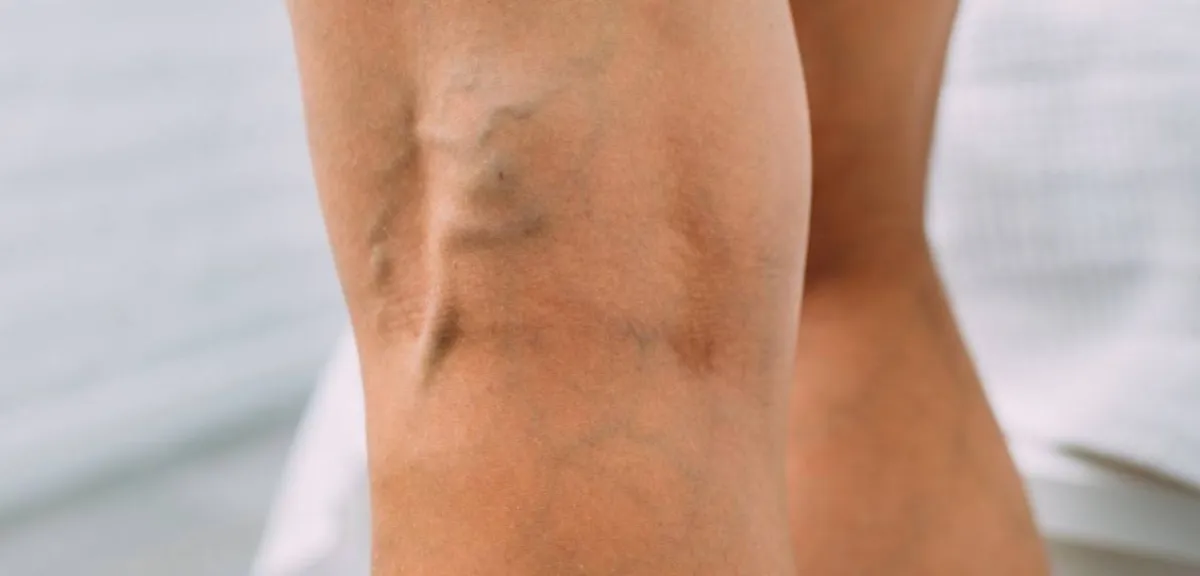 صورة لدوالي الساقين