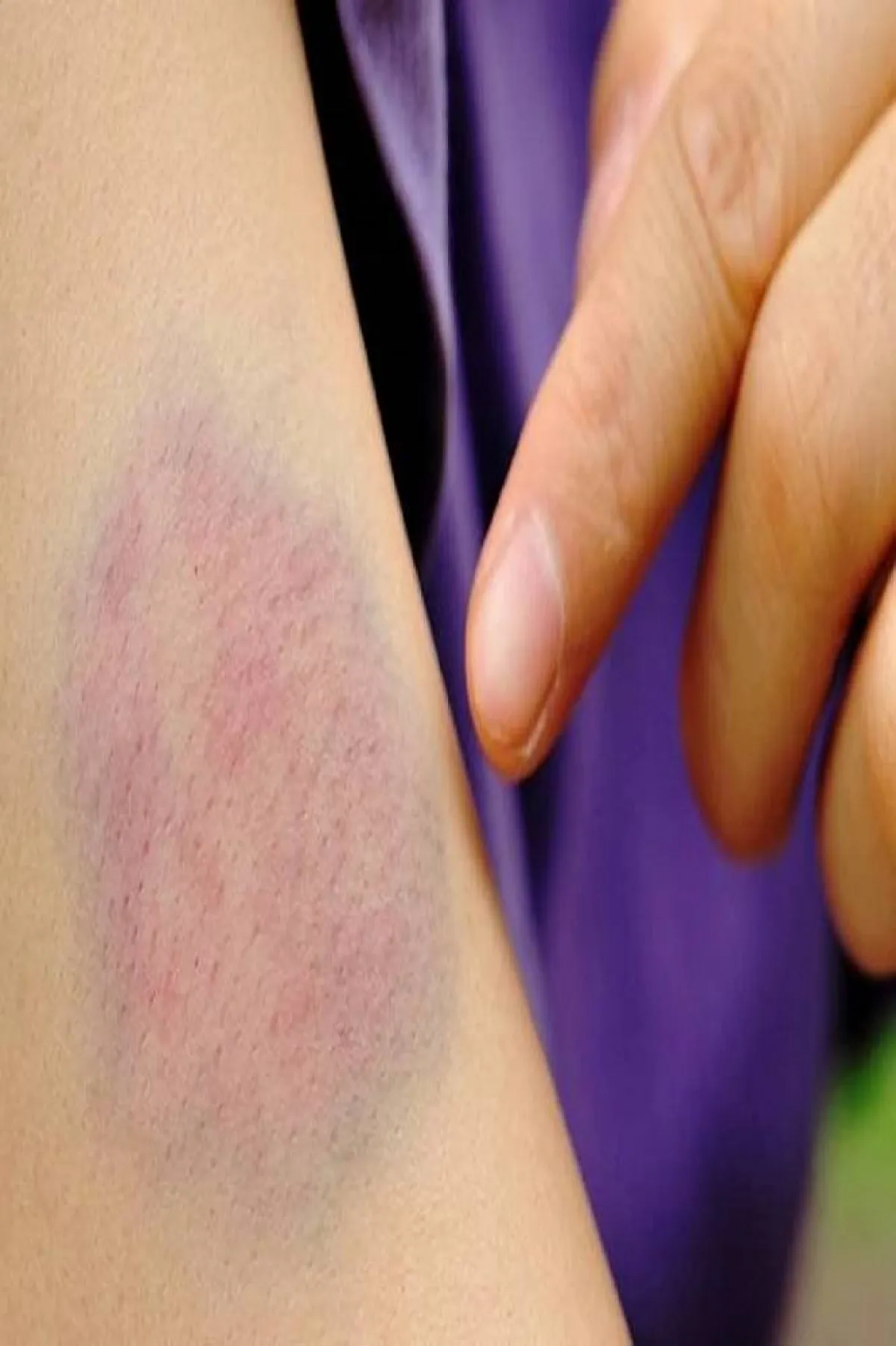 هكذا تبدو الكدمات على الجسم