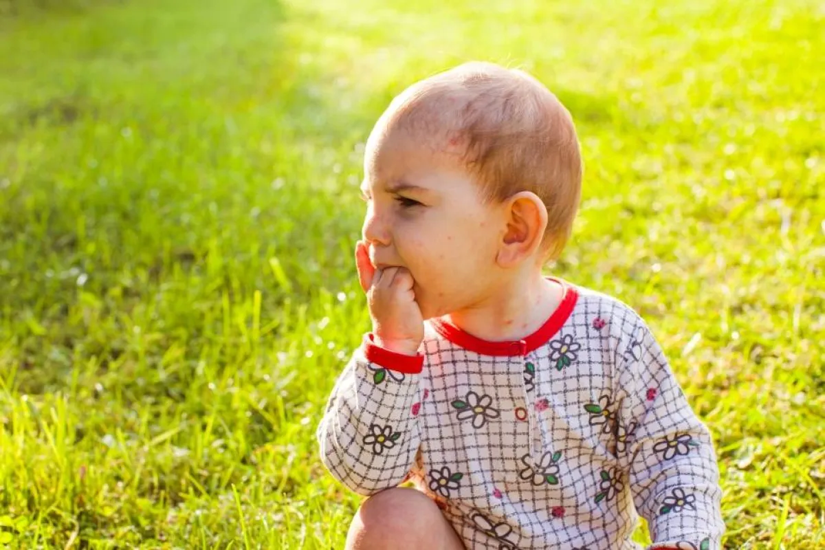 صورة لرضيع يعاني من الطفح الجلدي المقلق