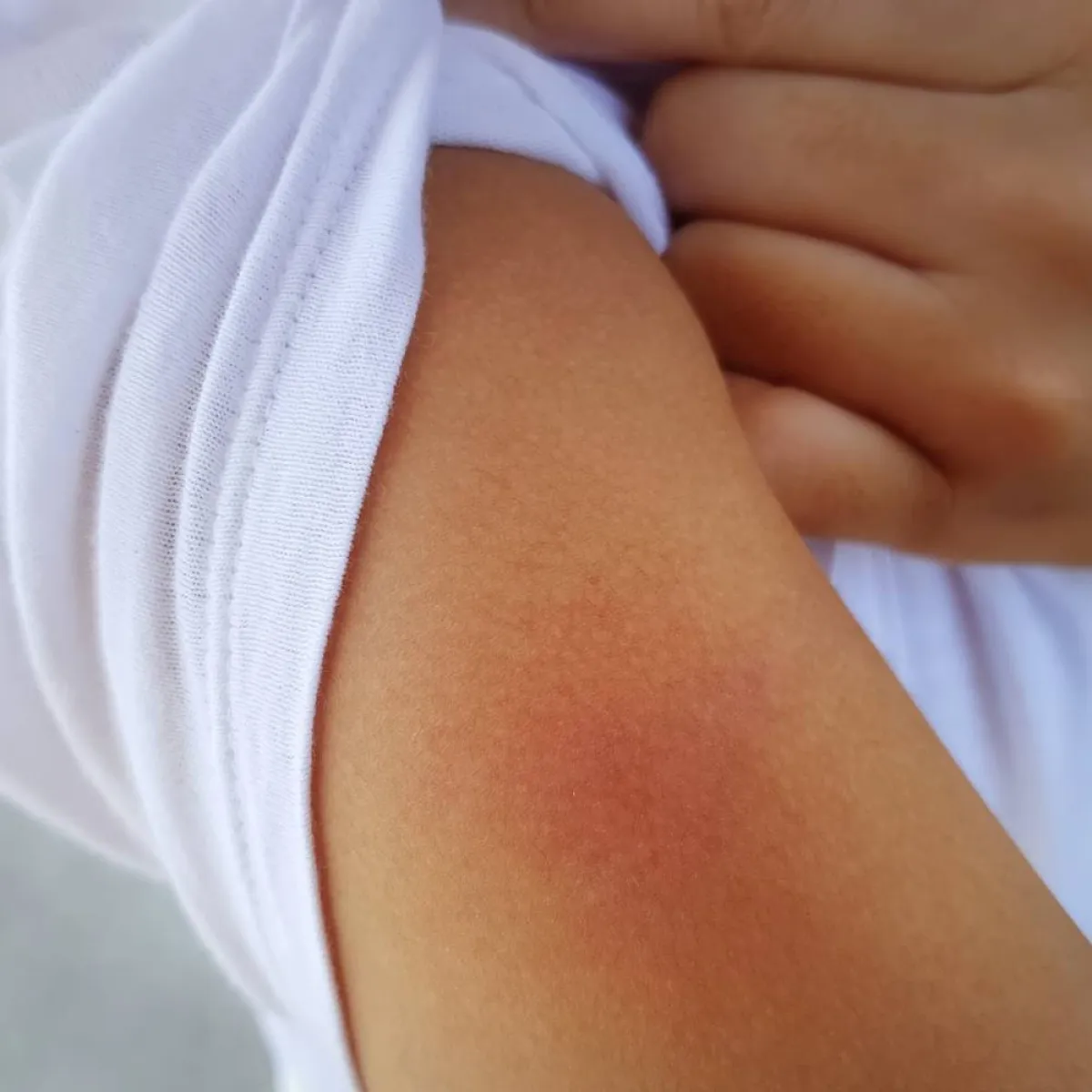 صورة ليد عليها طفح جلدي