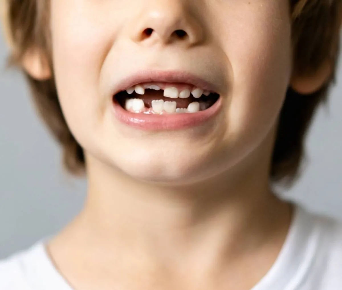 صورة لطفل يعاني من تشوه الأسنان بسبب نقص فيتامين د