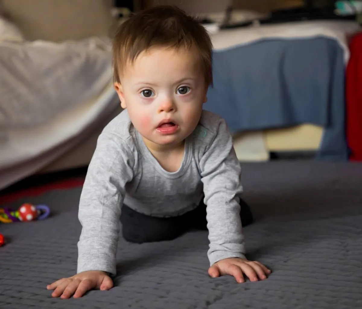 صورة لطفل يعاني من أعراض واضحة في سن المهد للمتلازمة