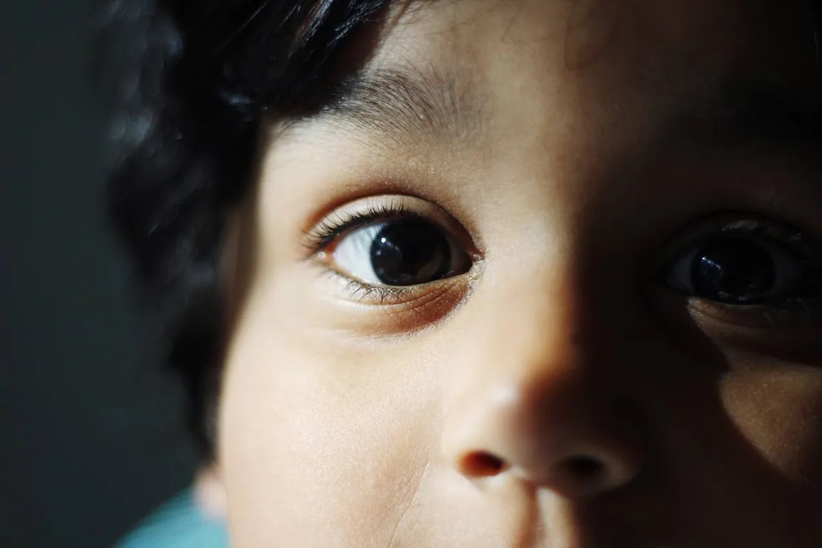 طفل مصاب بالحول