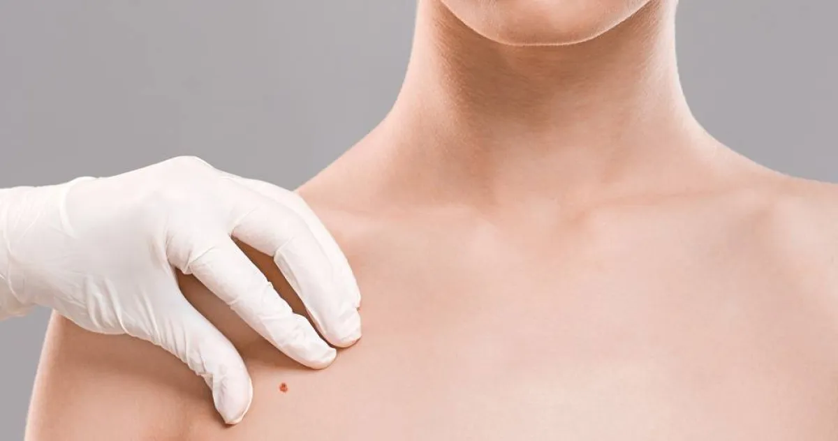 إزالة الشامة