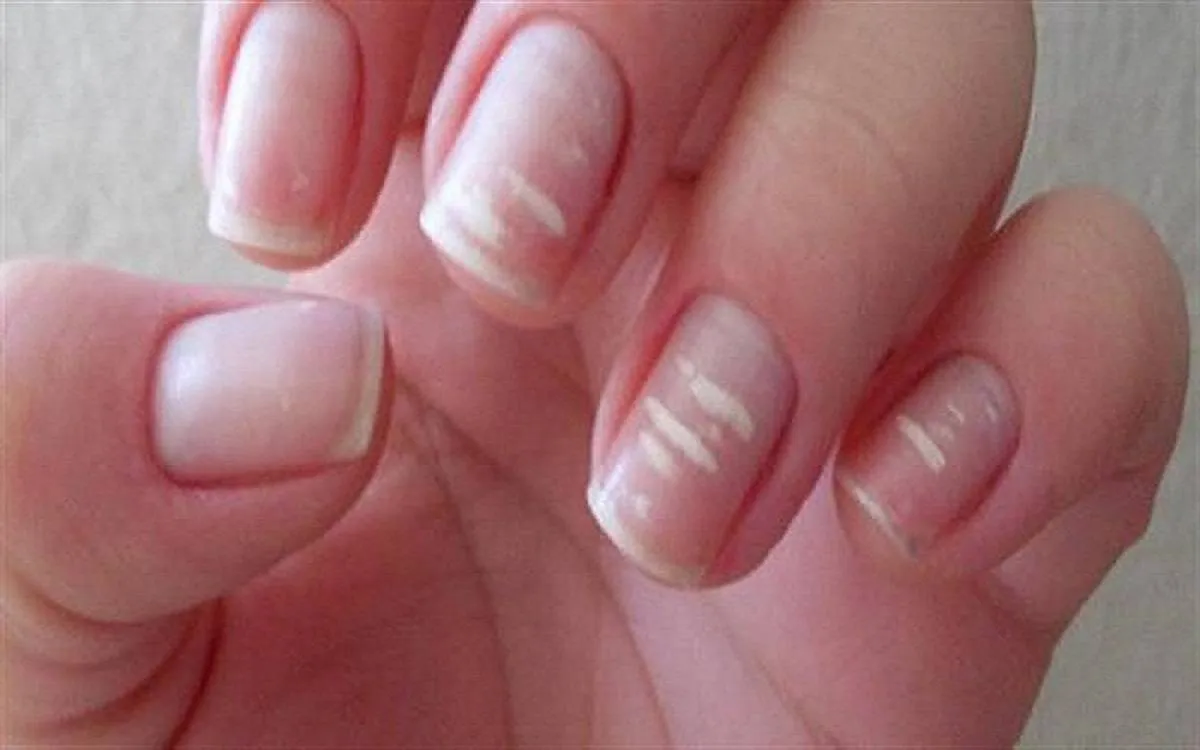 تعرجات الأطفار قد تؤشر على وجود مشكلة في القلب