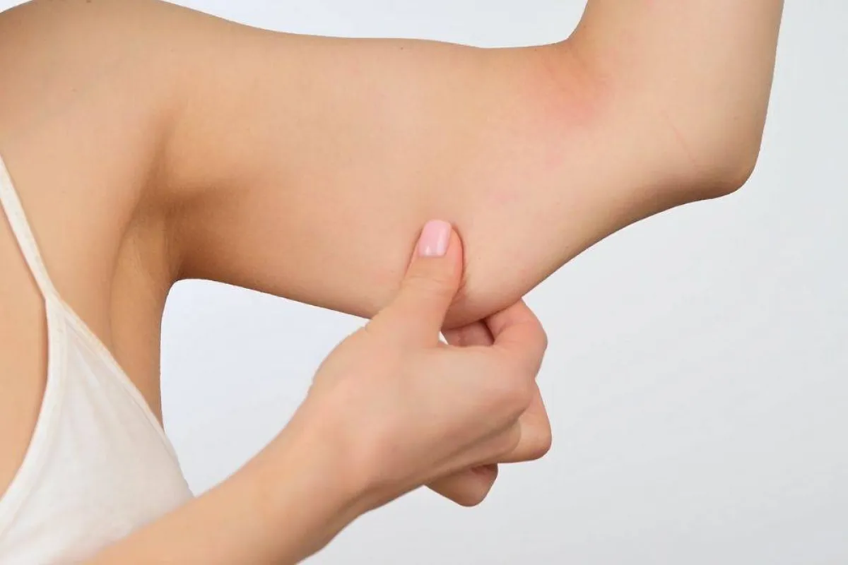 ترهل الذراعين