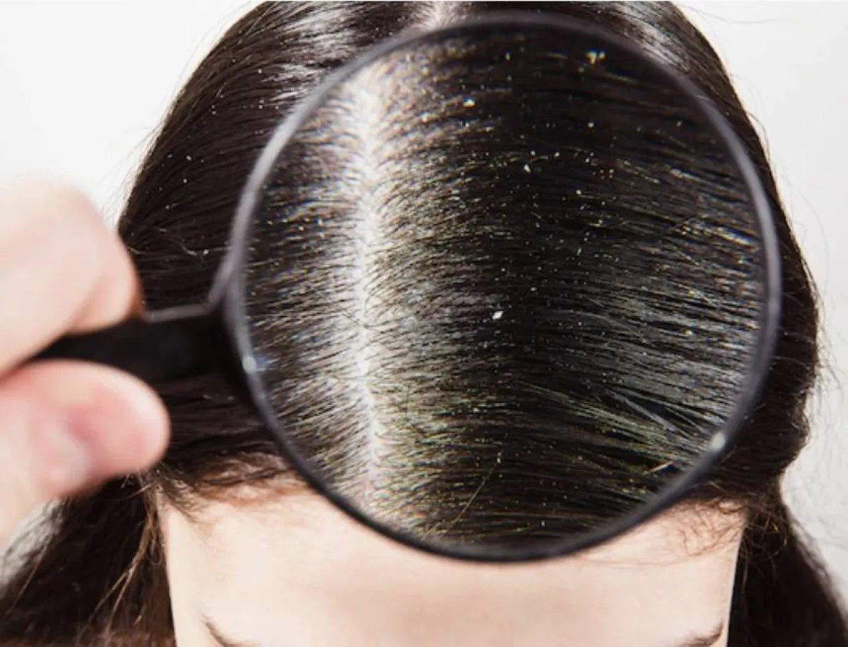 القشرة في الشعر