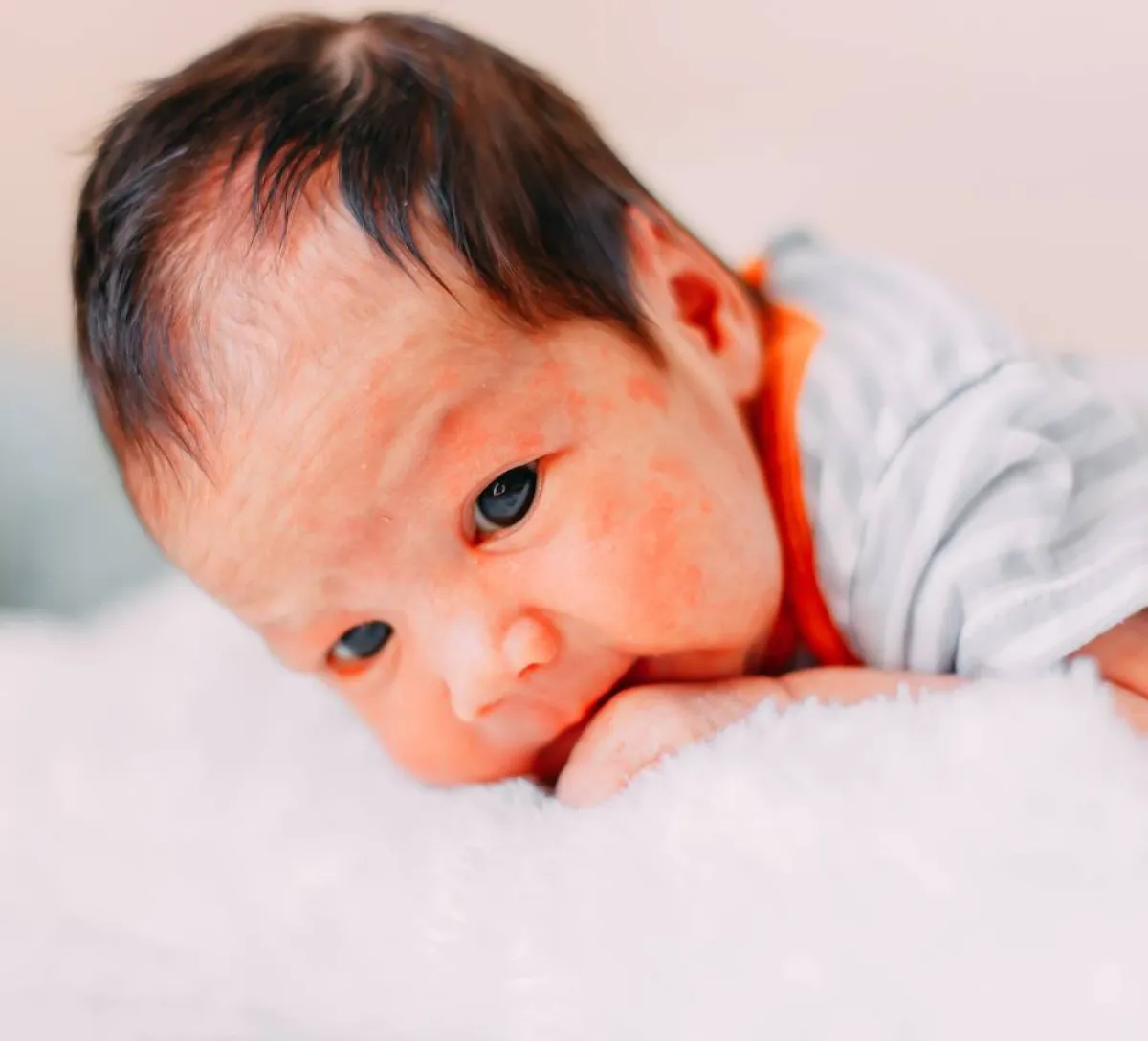 صورة لمولود مصاب بالطفح الجلدي