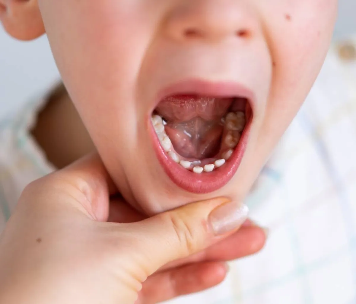 صورة لأضرار صرير الأسنان