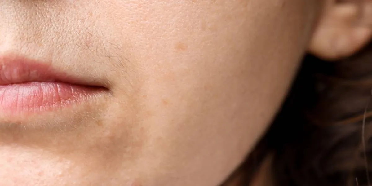 صورة البقع السوداء على الوجه