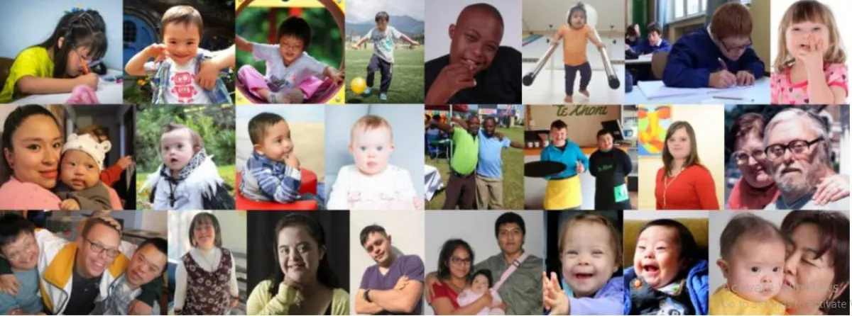 متلازمة داون 