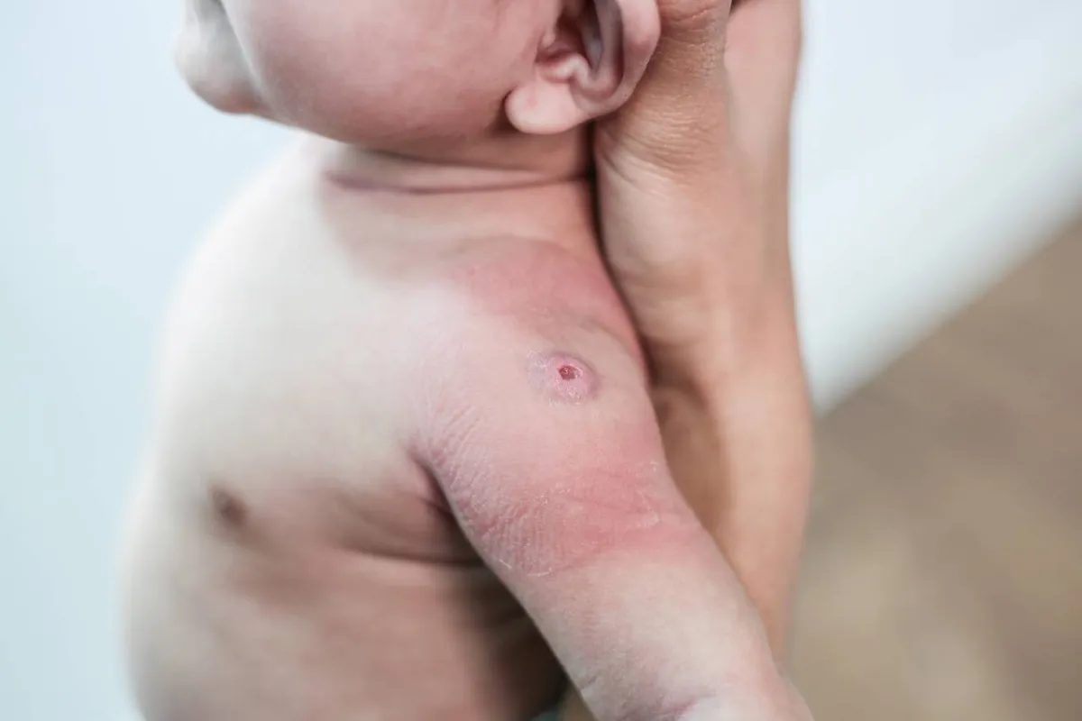 صورة لمولود مصاب بالأكزيما